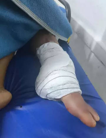 Diarista tem perna amputada após acidente na BR-163
