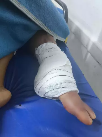 Diarista tem perna amputada após acidente na BR-163